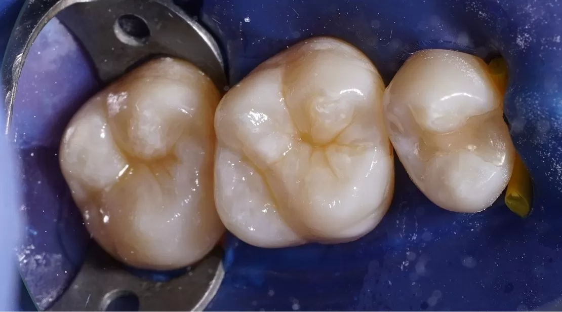 Микроинвазивное лечение кариеса 5 и 6 зуба. Восстановление анатомии.
